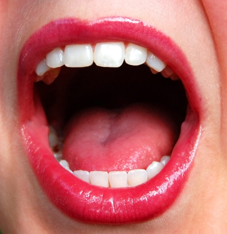 Implantes dentales en Gandía : Sistema «All on Four» de prótesis de arcada completa