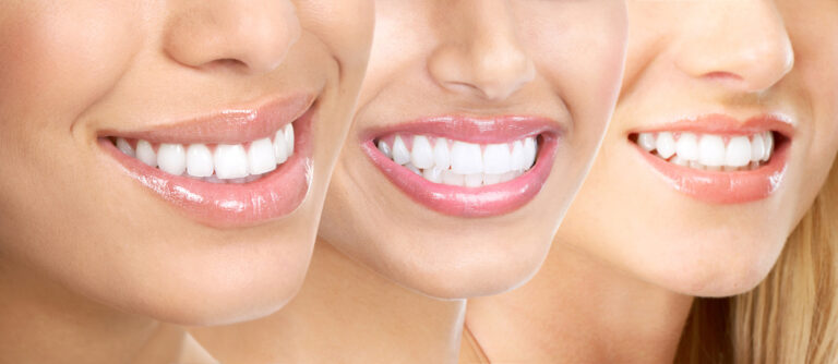 Blanqueamiento dental en Gandia