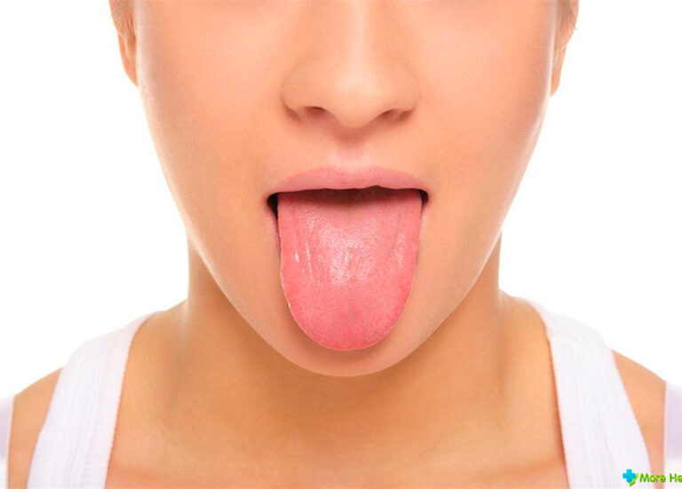 Glositis, la inflamación de la lengua