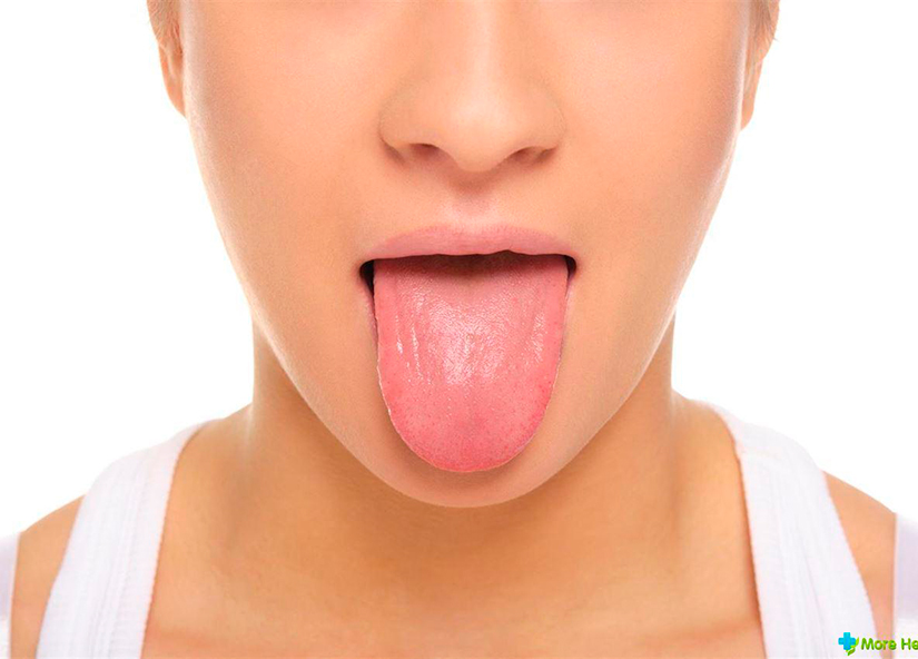 Glositis, la inflamación de la lengua