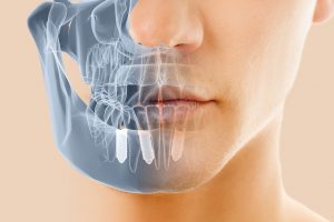 Implantes Dentales Gandia