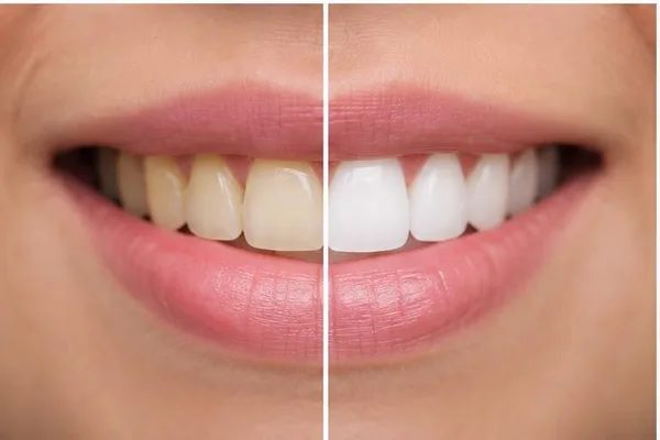Antes y después de blanqueamiento dental
