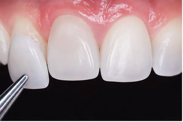Colocación de carilla dental con pinza