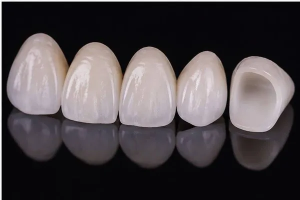 Carillas de porcelana