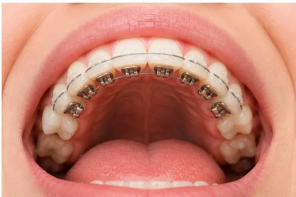 Vista intraoral completa con brackets metálicos